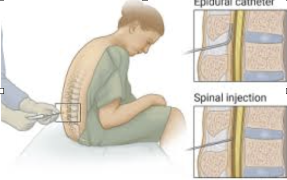 Epidural catheter placement diagram